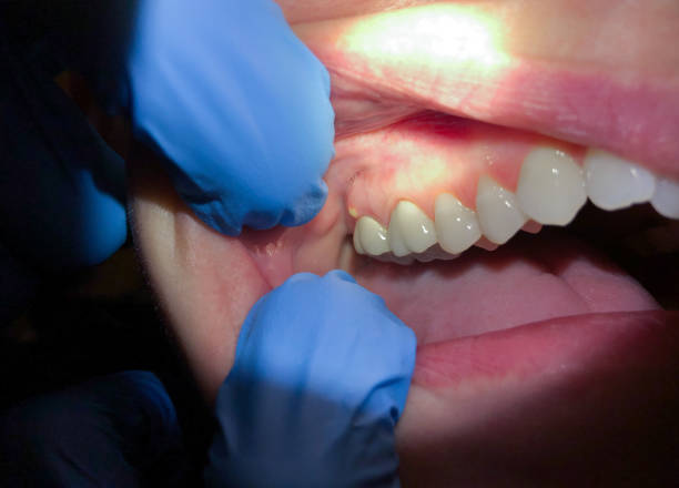 Best Emergency Tooth Extraction in Redwood Valley, CA