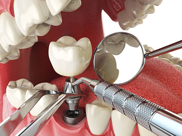 Best Emergency Denture Repair in Redwood Valley, CA